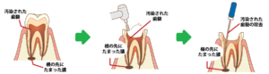 歯内療法とは?