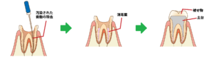 歯内療法とは?
