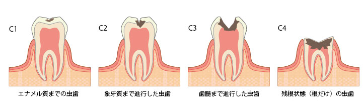 歯周病治療